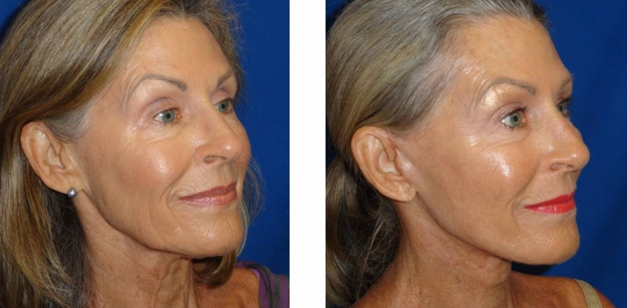 Facelift Before And After Woman Over 50 