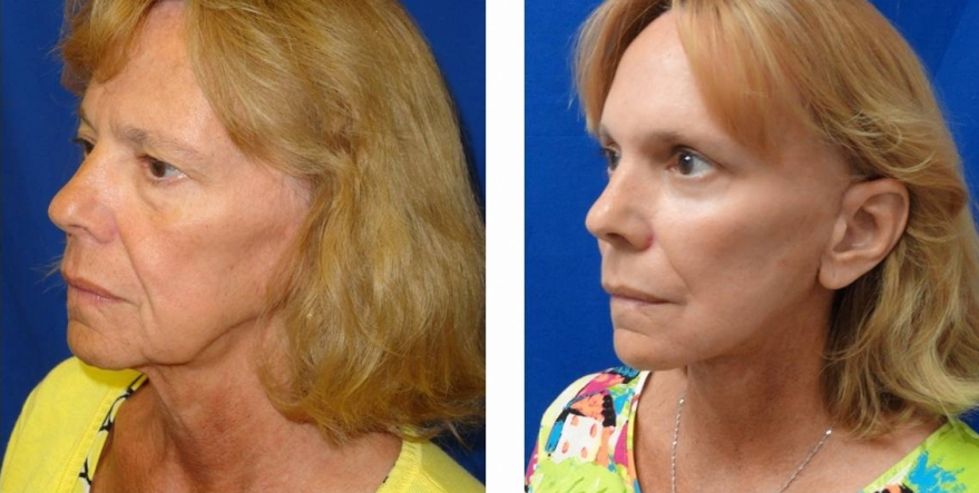 Facelift Before And After Woman1 