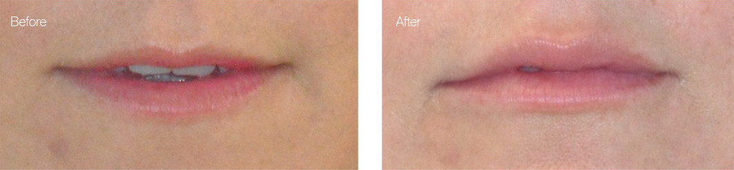 juvederm before and after photo (dermal filler for lips): orlando patient
