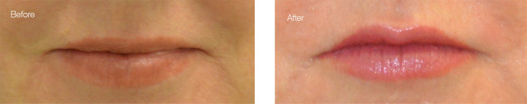 juvederm before and after photo (dermal filler for lips): female patient in orlando