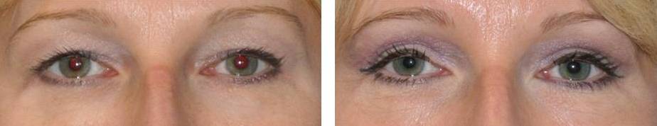 upper eyelid surgery (blepharoplasty) before and after photo: 41 year old female (orlando)