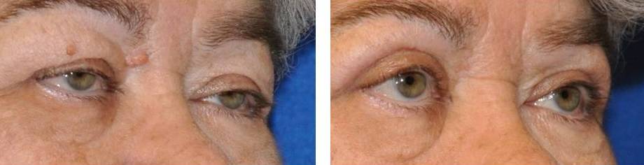 upper eyelid surgery (blepharoplasty) before and after photo: 72 year old female