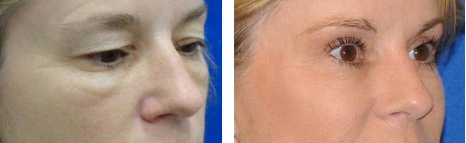 juvederm before and after photo: 48 year old female patient in orlando, fl
