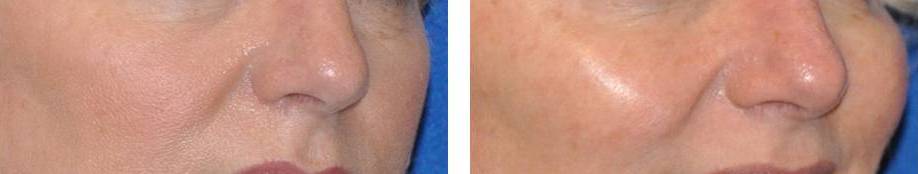 juvederm before and after photo: 51 year old female patient in orlando, fl