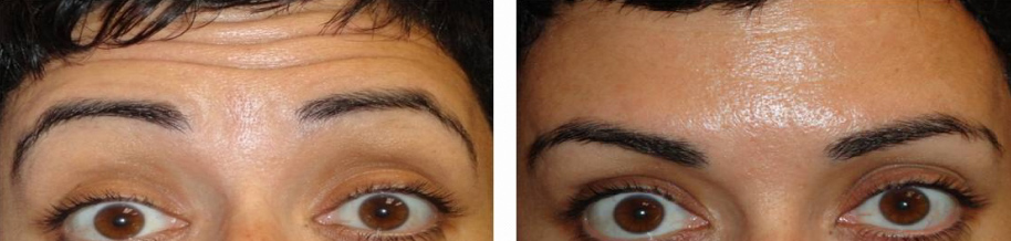 botox before and after photo: 43 year old female (forehead lines)