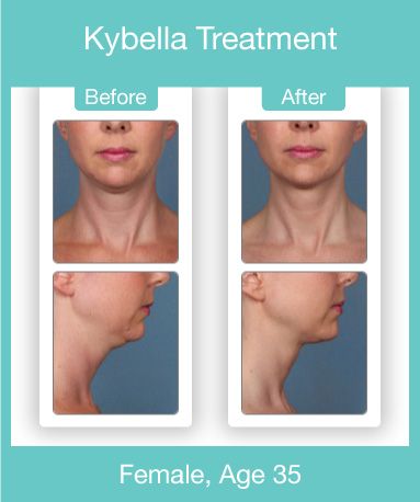 Kybella before and after pictures for 35 year old woman