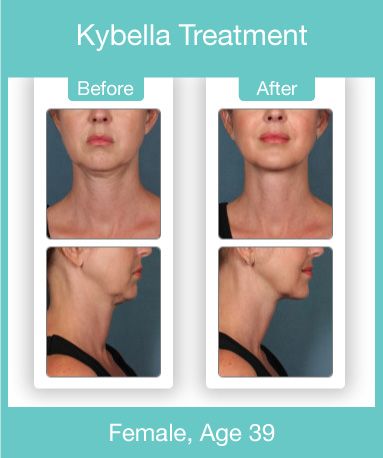 Kybella before and after pictures for 39 year old woman