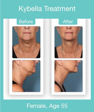 Kybella before and after pictures for 55 year old woman