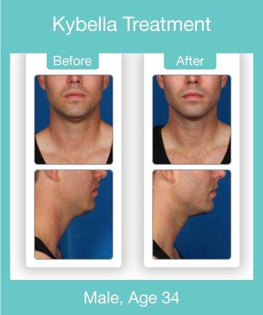 Kybella before and after pictures for 34 year old male