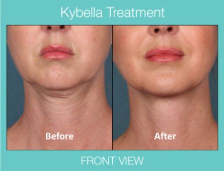 Kybella treatment front view before and after pictures