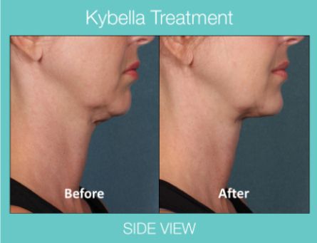 Kybella treatment side view before and after pictures