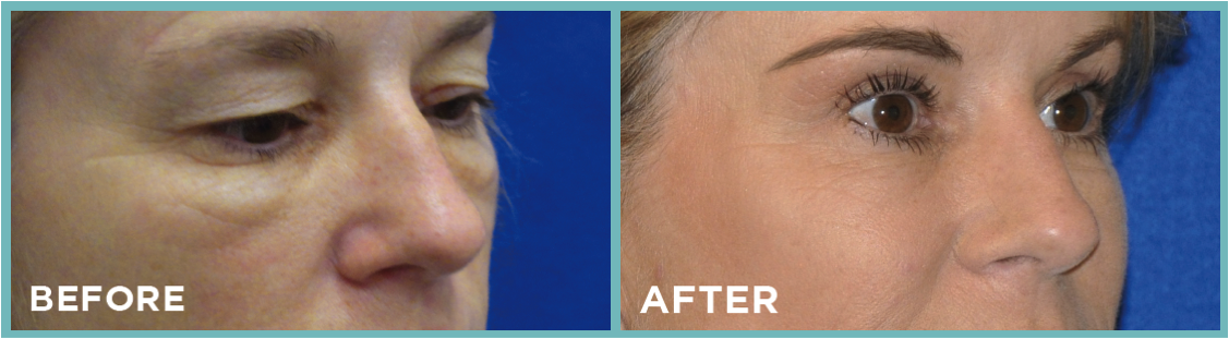 Juvederm Cheeks Before and After Photograph