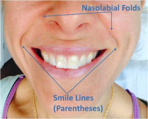 Nasolabial Folds Graphic