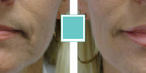 Juvederm Before and After Gallery Thumbnail Image