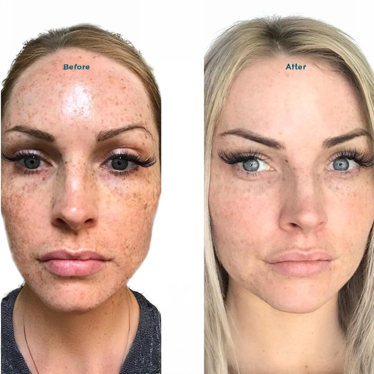 B&A11