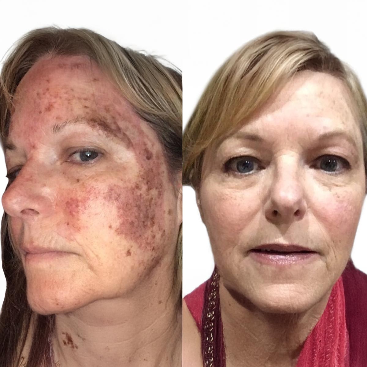 chemical peels Orlando