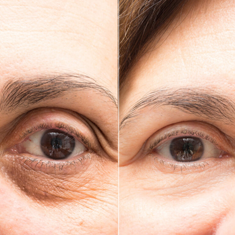 Blepharoplasty-7 Image description