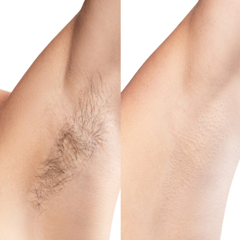 Laser-Hair-Removal-5