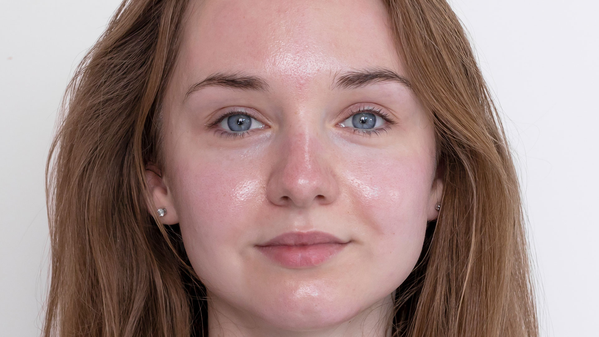 woman face wrinkles before and after treatment