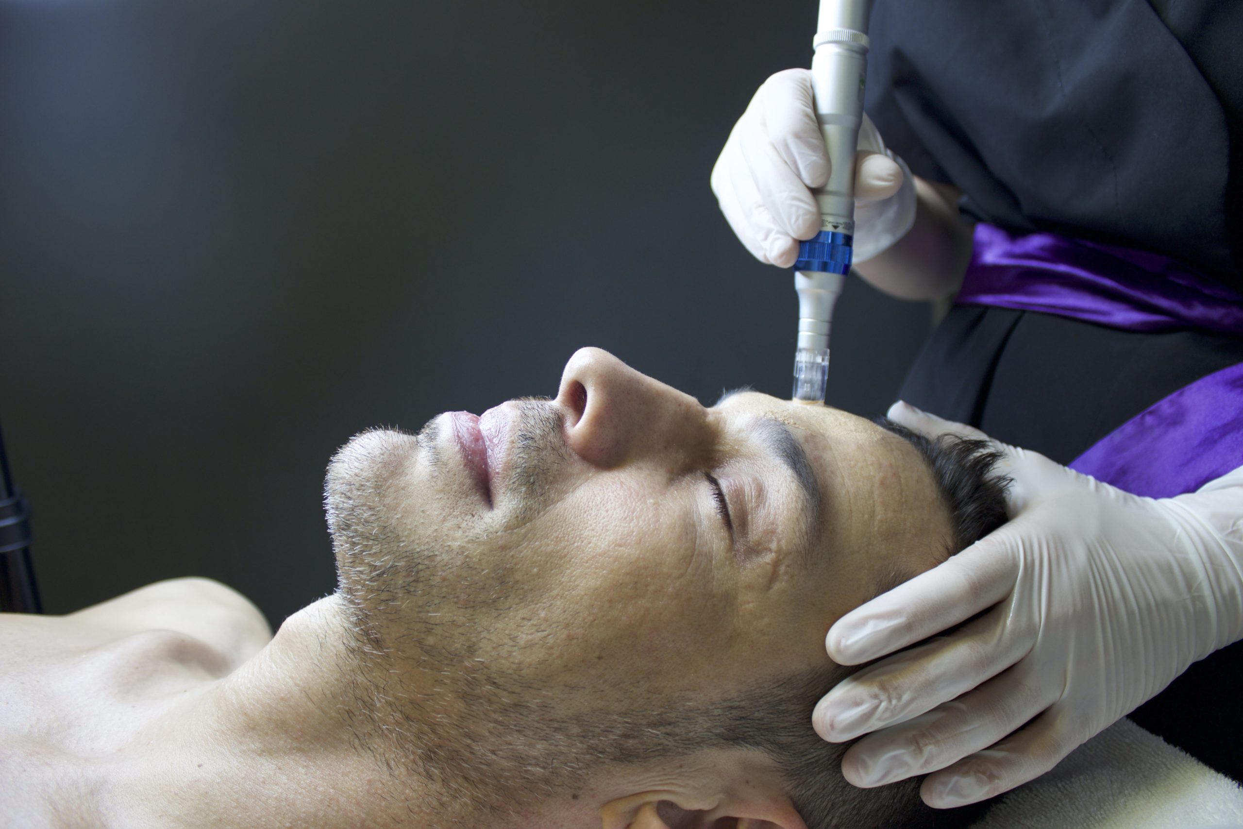 Microneedling-Two-scaled