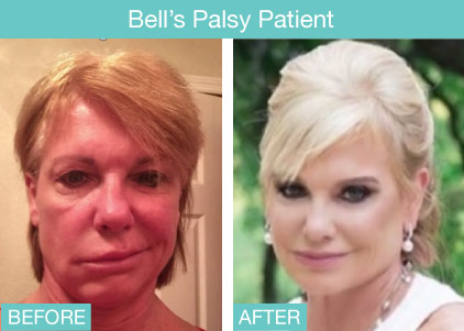 bells palsy patient before and after photo
