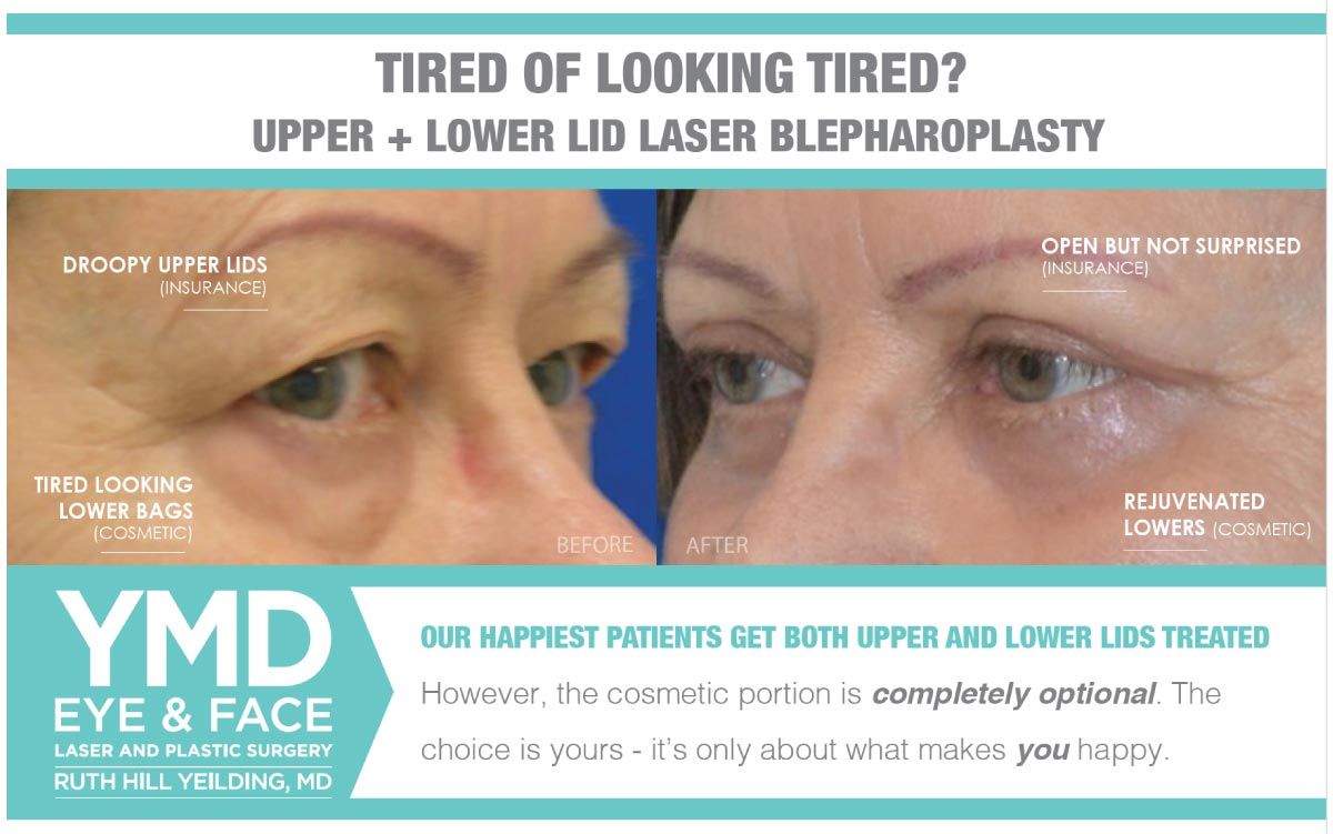 Grahic titled "Tired of Looking Tired? - Upper + Lower Lid Laser Blepharoplasty" that shows a before and after photo of woman that received both upper and lower blepharoplasty, and highlights insurance covered treatment area (droopy upper lids) versus cosmetic treatment area (tired-looking lower bags) and says "Our happiest patients get both upper and lower lids treated. However, the cosmetic portion is completely optional. The choice is yours - it's only about what makes you happy."