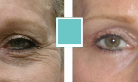 Eyelid Surgery Before and After Photos Thumbnail Image