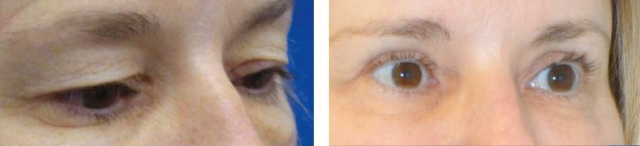 orlando eyelid surgery before and after photo, female, age 48