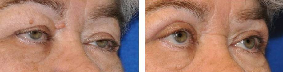 blepharoplasty-upper-eyelid-surgery-72-year-old-female