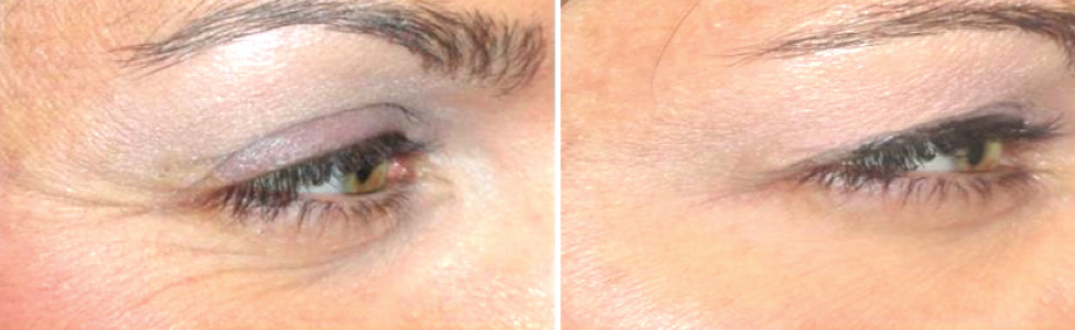 Botox for Crows Feet Before and After Photo