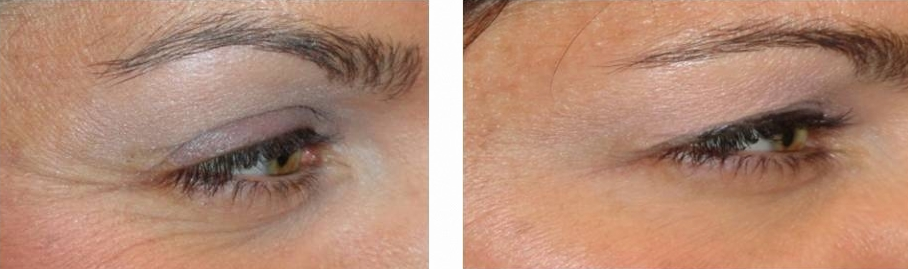 botox before and after photo: 30 year old female (crow's feet)