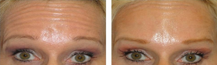 botox before and after photo: 43 year old female (for forehead lines)