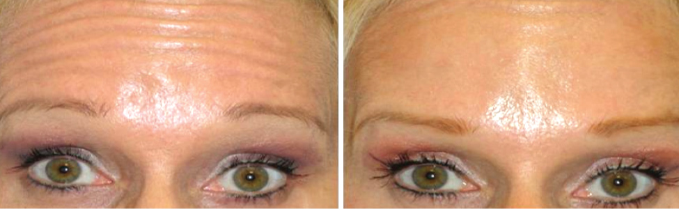 Botox Treatment for Forehead Lines Before and After Photo