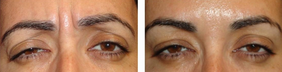 botox before and after photo: 43 year old female (glabella lines)