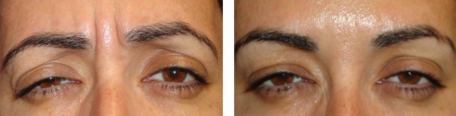 Botox Before And After Women : Botox Before and After Pictures | Cosmetic Dermatology ... - Michael weinberg, botox before and after photo (toronto, canada).