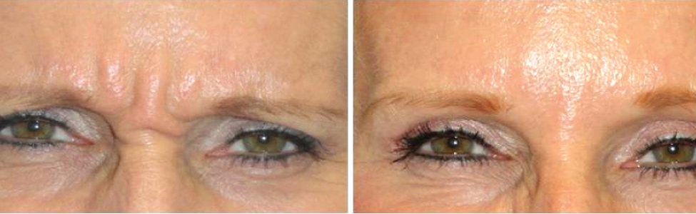 Botox Treatment for Glabellar 11s Lines Before and After Photo