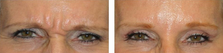 orlando botox before and after photo: 54 year old woman (for frown lines)