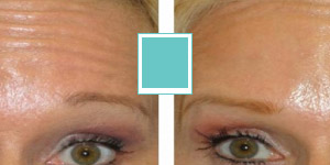 Orlando Botox Before and After Photo Gallery Thumbnail Image
