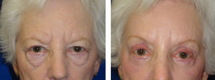 Brow Lift Before and After Photo of Patient