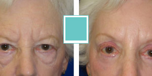 browlift-before-and-after-gallery