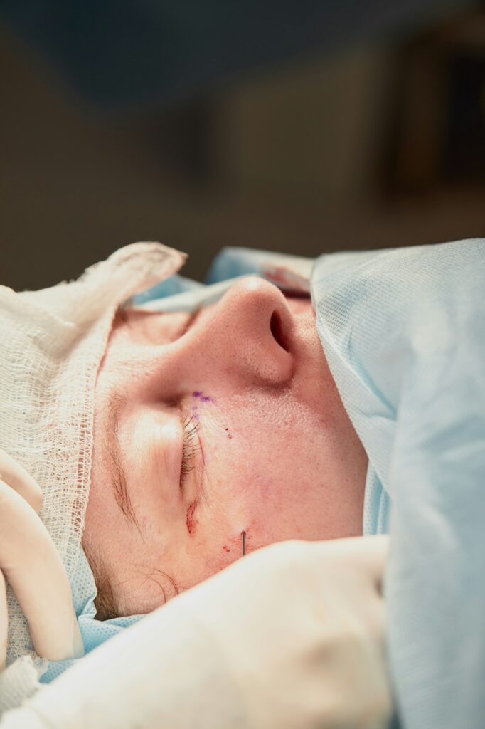 Close up of the face of a patient who is undergoing blepharoplasty. The surgeon cuts the eyelid and