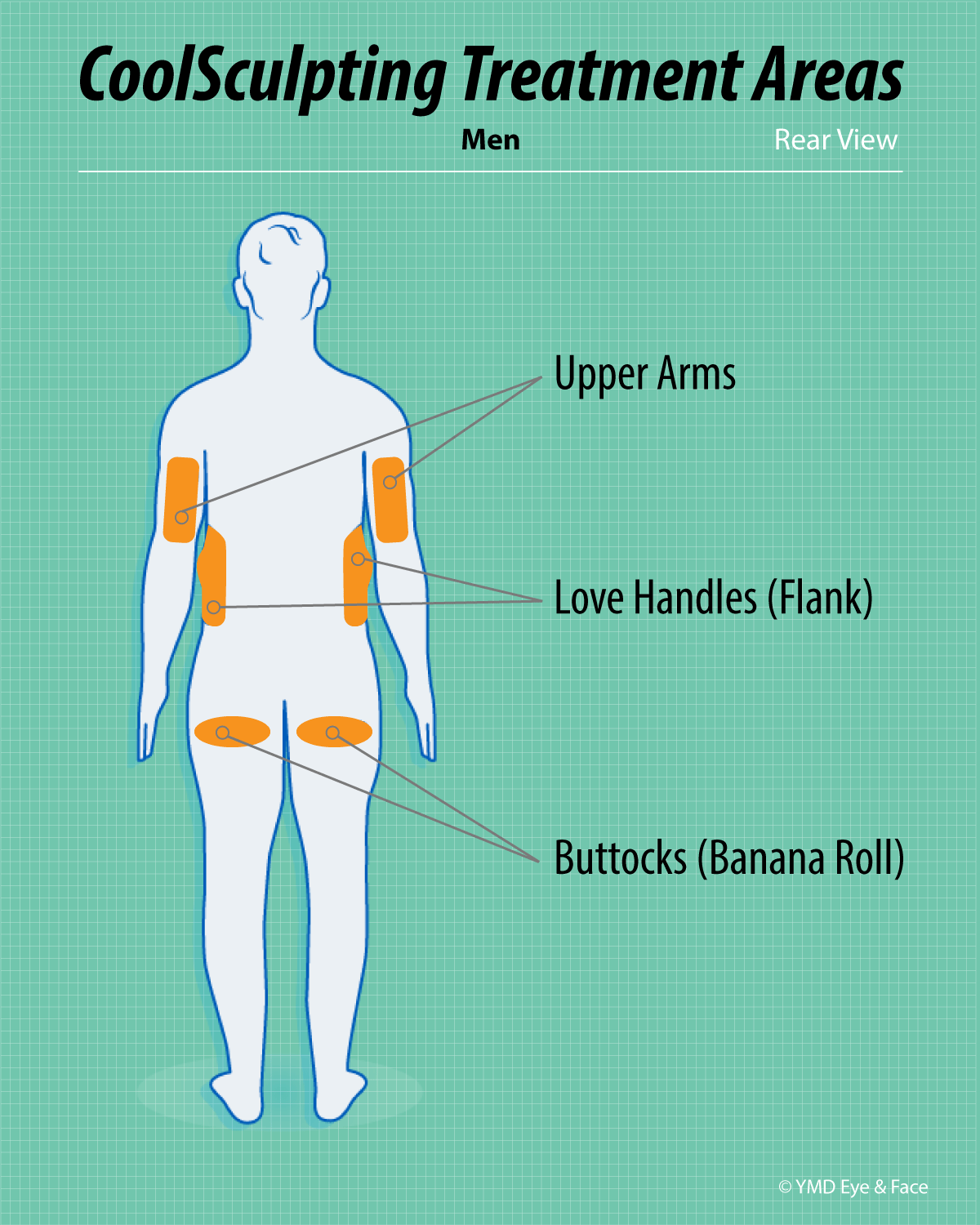 CoolSculpting graphic highlighting possible treatment areas for men (rear view): upper arms, love handles (flanks), buttocks (banana roll)