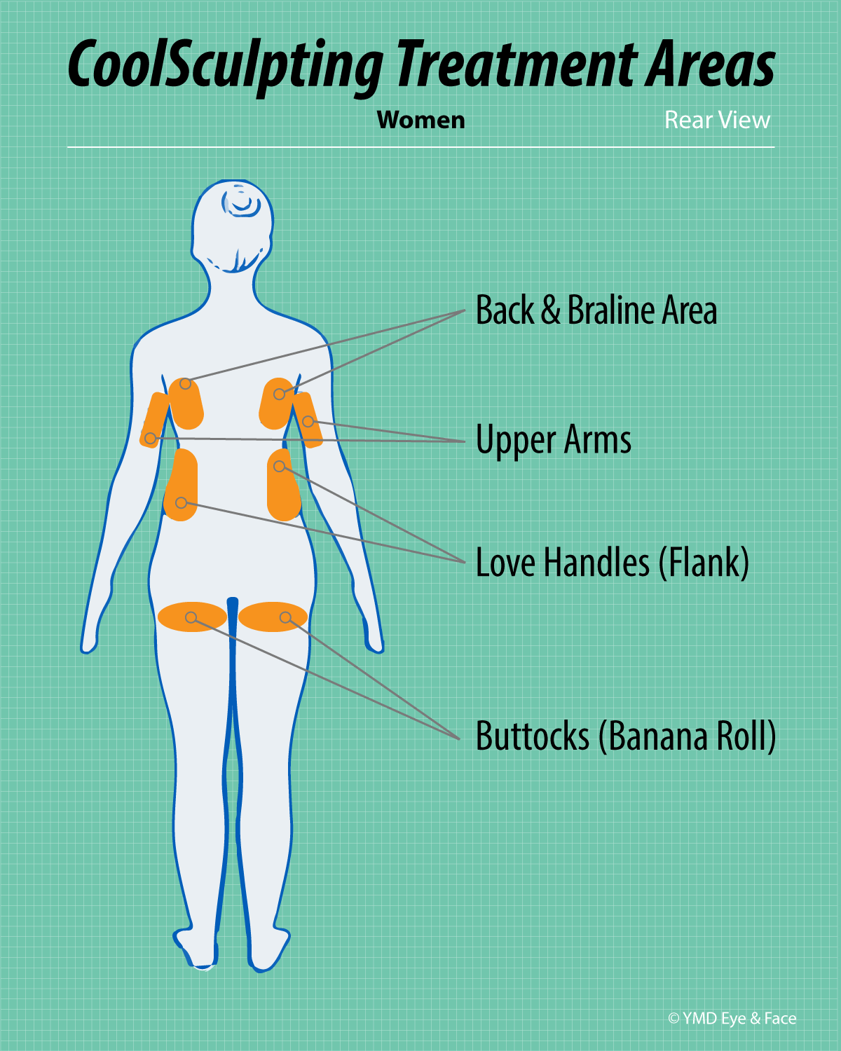 CoolSculpting graphic highlighting possible treatment areas for women (rear view): back and braline fat, upper arms, love handles (flanks), buttocks (banana roll)