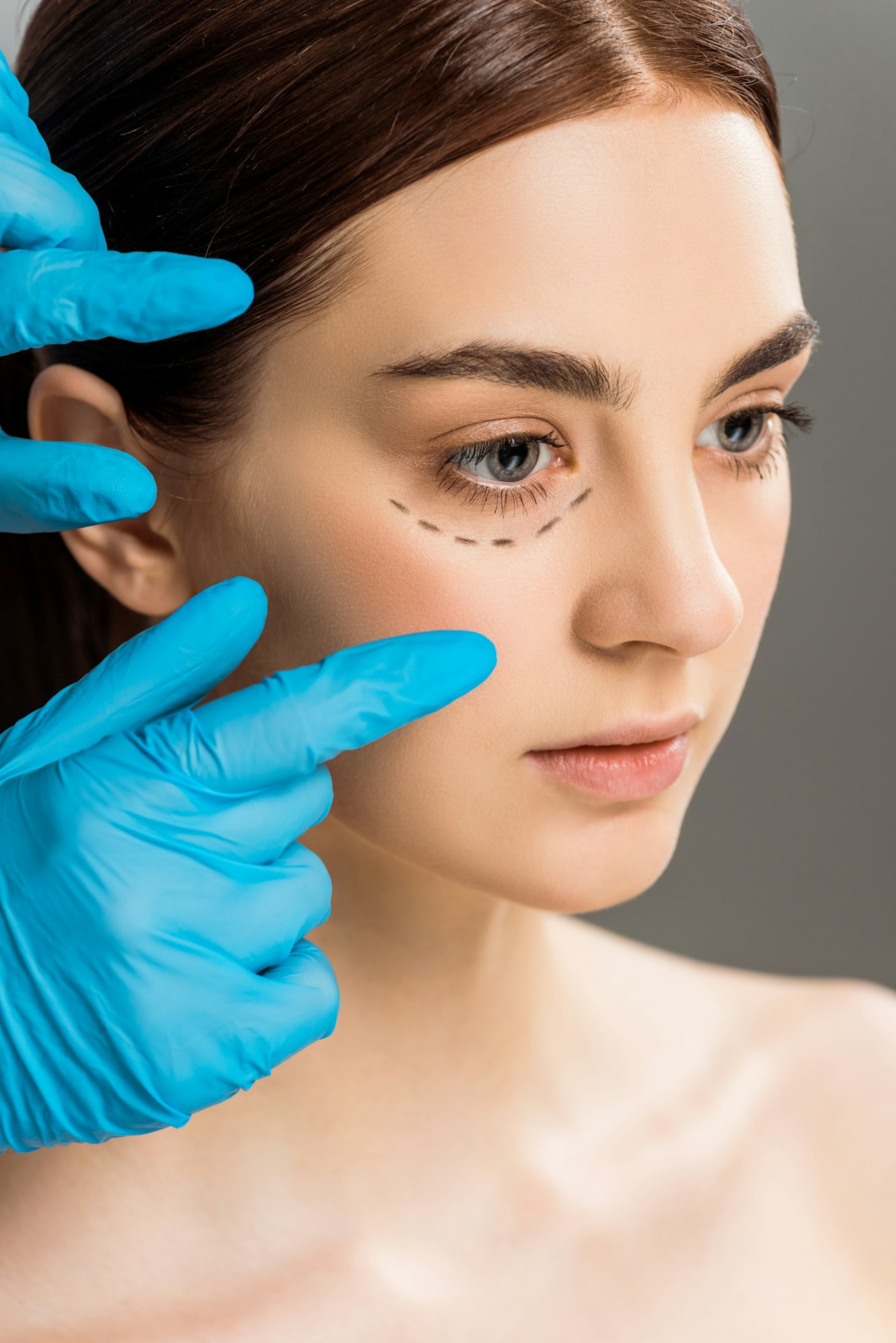 Young woman's face with surgical markings for lower blepharoplasty procedure