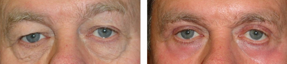upper and lower eyelid surgery (blepharoplasty) before and after photo: 63 year old male (orlando)