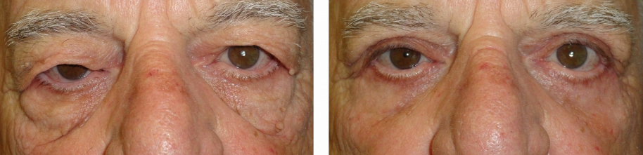 upper and lower eyelid surgery (blepharoplasty) before and after photo: 78 year old male (orlando)