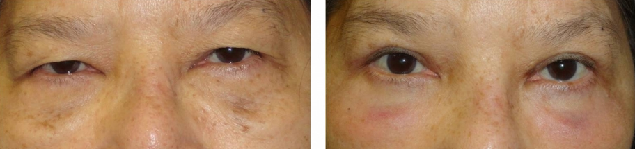 upper and lower eyelid surgery (blepharoplasty) before and after photo: 69 year old female (orlando)