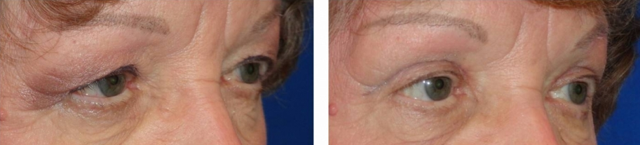 upper eyelid surgery (blepharoplasty) before and after photo: 77 year old female (orlando)