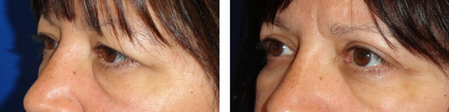 upper and lower eyelid surgery (blepharoplasty) before and after photo: 47 year old female (orlando)