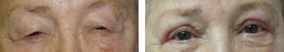 upper eyelid surgery (blepharoplasty) before and after photo: 78 year old female (orlando)